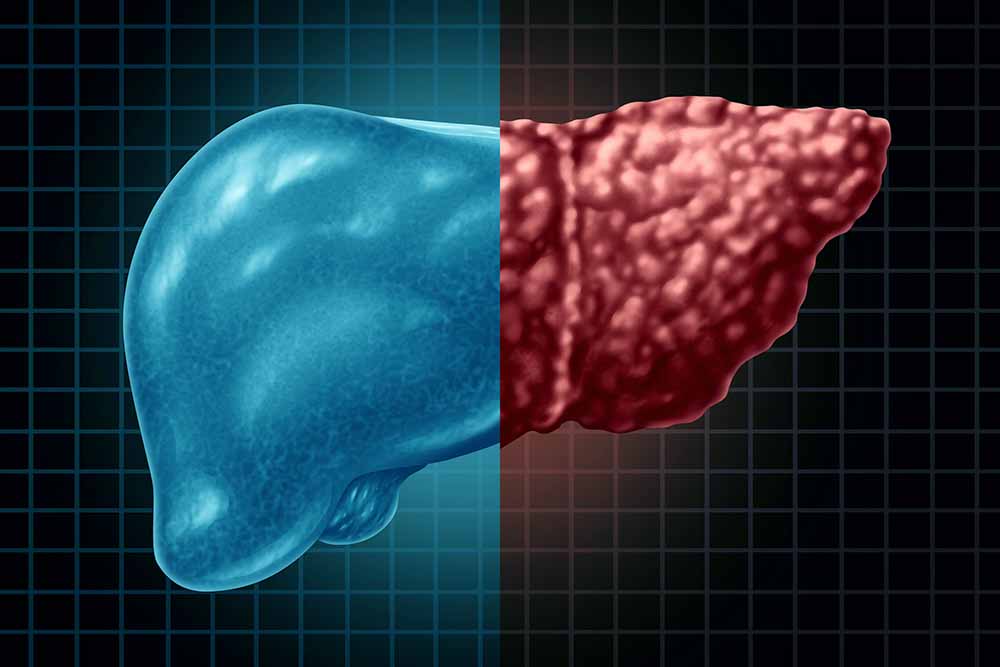 الفرق بين تليف الكبد وتشمع الكبد