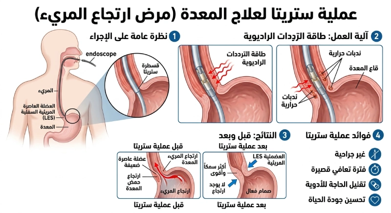 شرح مصور لعملية ارتجاع المرئ ستريتا
